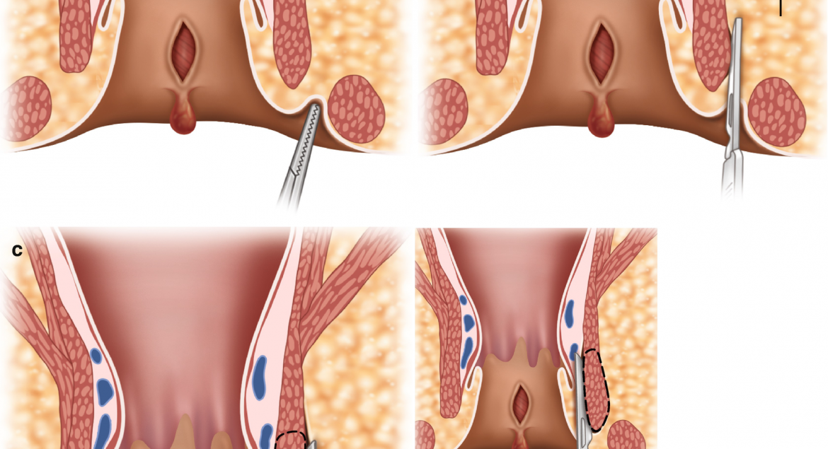 Anal fissure