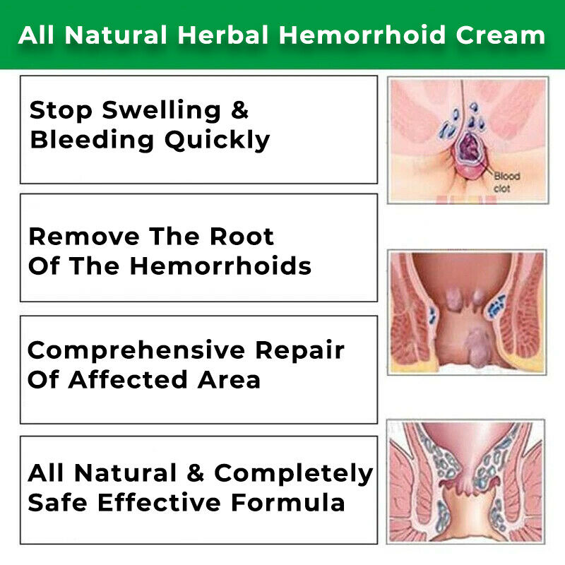 Hemorrhoid Anus Cream (5)