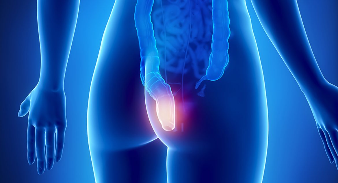 Prevent Hemorrhoids