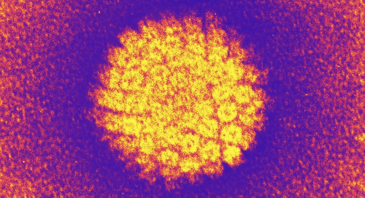 The human papilloma virus causes most cervical cancers. That's why HPV testing is now recommended for women ages 30 to 65.
